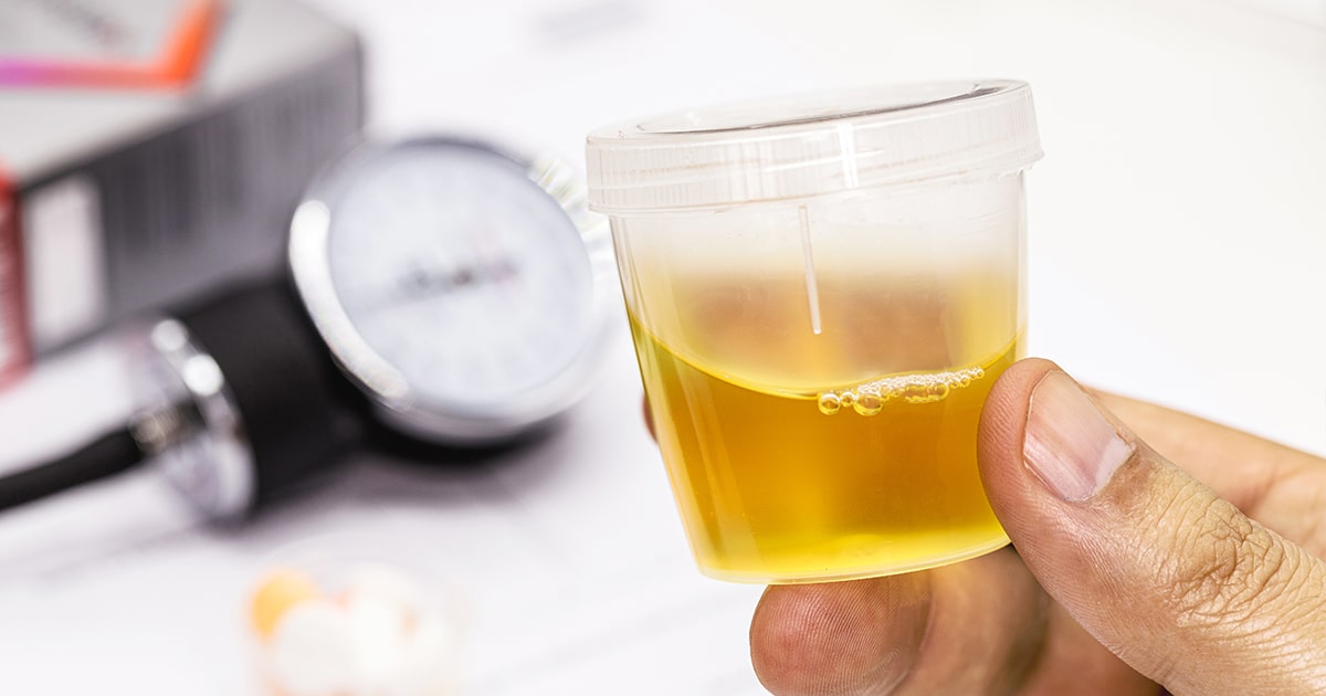 Can A Urinalysis Detect Liver Problems